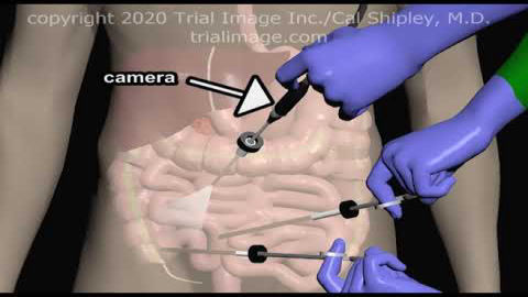 Review of laparoscopic surgical procedure to remove an infected appendix GST404
Related Videos:  https://trialimage.com/gastrointestinal-animation-library/#appendix